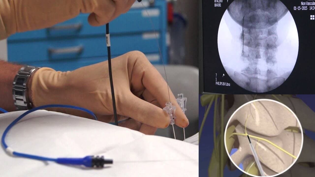 radiofrequency ablation procedure radiofrequency ablation procedure