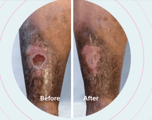 Before-and-after-Varithena-treatment Before and after Varithena treatment