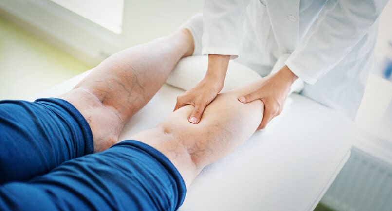 Varicose-Spider-Vein-Treatment Varicose Spider Vein Treatment