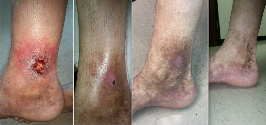 Venous-ulcer-Treated-with-Varithena-chemical-ablation Venous ulcer Treated with Varithena chemical ablation