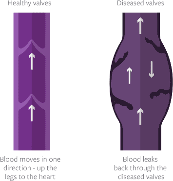 leg-vein-valves Leg Vein Valves