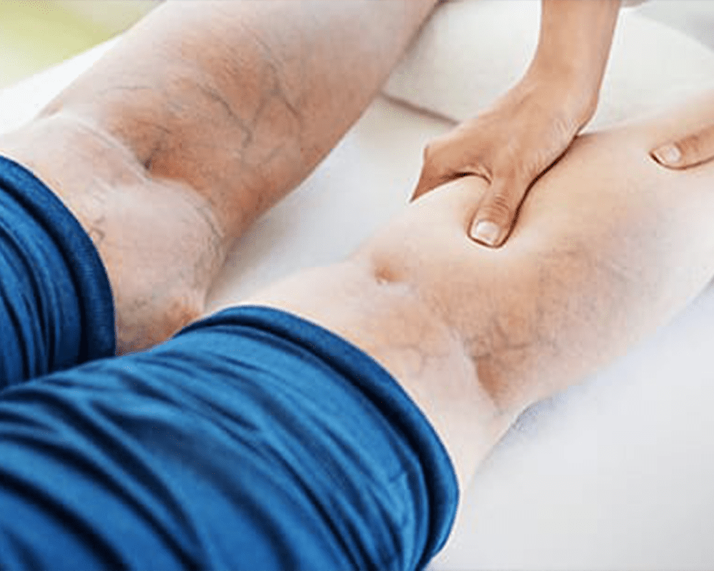 varicose-vein-treatment-options Varicose Vein Treatment in Canton, Georgia