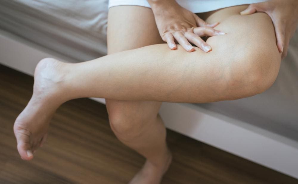 vein-treatment-procedures Procedures for Treating Varicose and Spider Veins