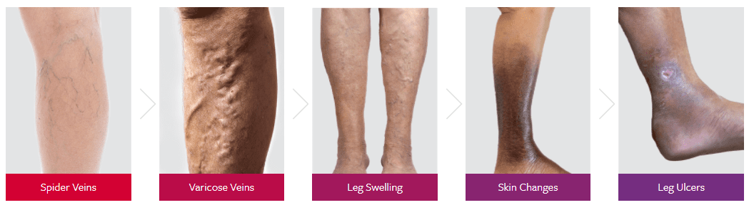 Vein Conditions Vein Conditions